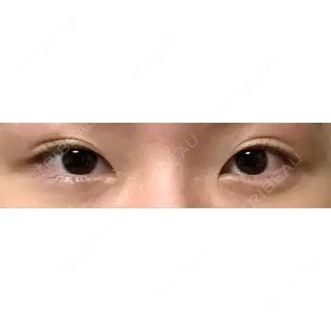 クマ治療 WOM CLINIC GINZA （ワム クリニック ギンザ） AFTER