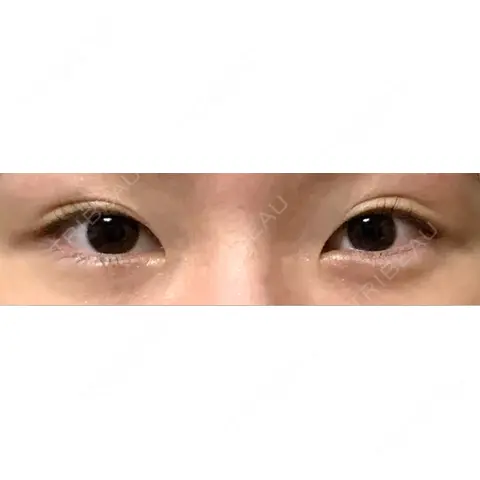 クマ治療 WOM CLINIC GINZA （ワム クリニック ギンザ） AFTER