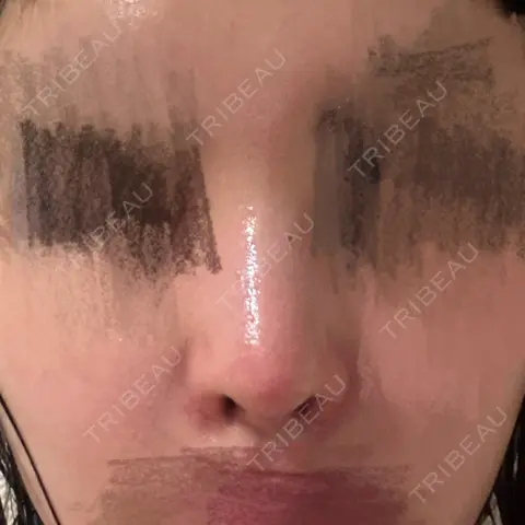 隆鼻術 / 鼻尖形成（切開） / 鼻中隔延長（切開） / 軟骨移植 / 鼻孔縁挙上 / 鼻孔縁下降 / 鼻翼基部形成（貴族手術） / その他（鼻） Designo Clinic （デジーノクリニック） AFTER
