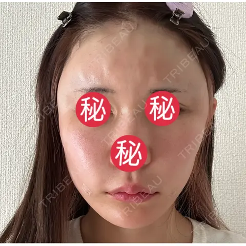 額を丸く / 脂肪注入（肌） / 脂肪注入（額） 湘南美容クリニック 柏院 DAY 0