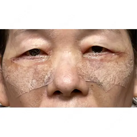 糸リフト / クマ治療 / 下まぶたたるみ取り / 下まぶたの脂肪取り WOM CLINIC GINZA （ワム クリニック ギンザ） DAY 1