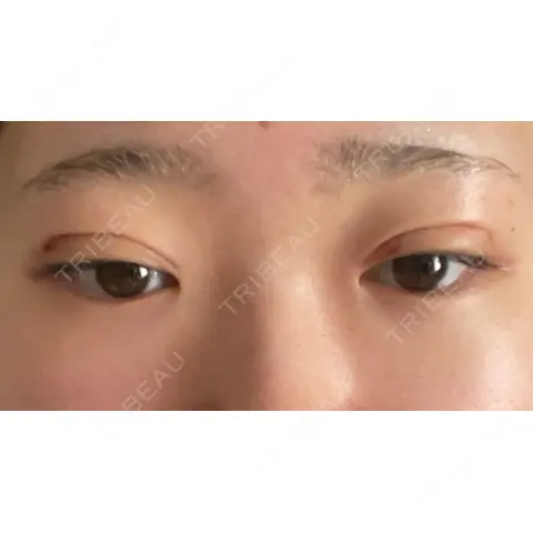 二重埋没 / 上まぶたの脂肪取り THE FIRST CLINIC 多摩センター院 DAY 1