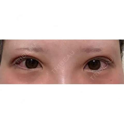 二重埋没 / 上まぶたの脂肪取り / ボトックス（眉間） / ボトックス（額） 藤・ナチュレ美容クリニック 銀座院 AFTER
