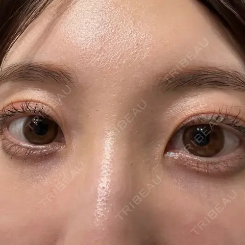 クマ治療 / 下まぶたの脂肪取り APOLLO BEAUTY CLINIC AFTER