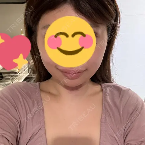 糸リフト / 脂肪吸引（顔） 脂肪吸引ラボトウキョウ DAY 1