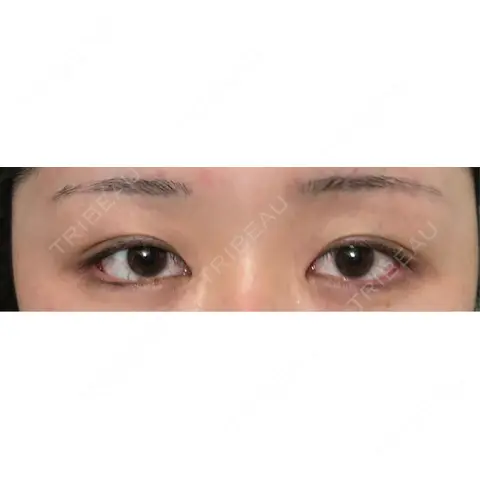 その他（目元） 麻布十番クレールデンタルクリニック AFTER