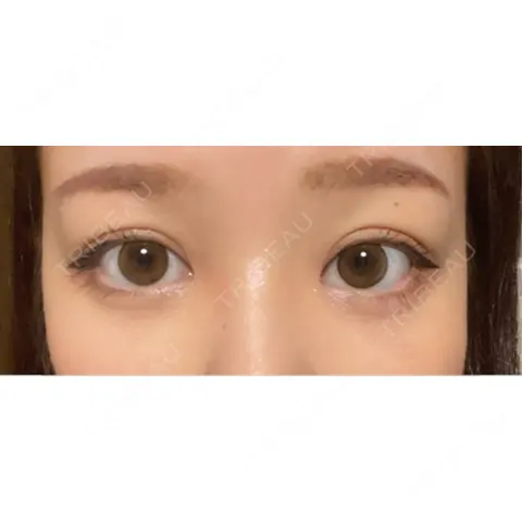 クマ治療 R Beauty CLINIC 大阪院 AFTER