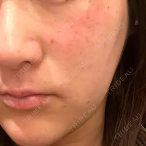 ピーリング（ハリ・ツヤ） / ルメッカ GLAMRULE CLINIC (グラムルール クリニック) 銀座院 DAY 0
