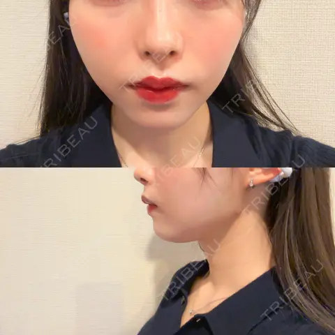 糸リフト DMTC美容皮膚科 日本橋院 DAY 1