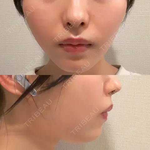 糸リフト DMTC美容皮膚科 日本橋院 AFTER