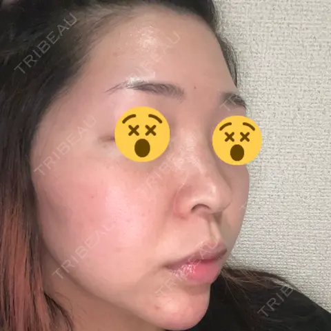 ボトックス（あご） / ボトックス（眉間） / ボトックス（額） / ピコレーザートーニング（美白・肝斑） / ピコフラクショナルレーザー（毛穴・ニキビ跡） 東京シルククリニック 新宿院 AFTER