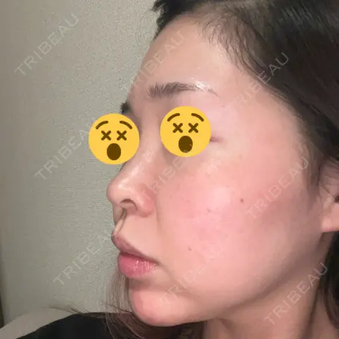 ボトックス（あご） / ボトックス（眉間） / ボトックス（額） / ピコレーザートーニング（美白・肝斑） / ピコフラクショナルレーザー（毛穴・ニキビ跡） 東京シルククリニック 新宿院 AFTER