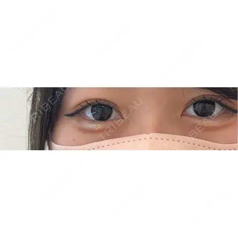 二重埋没 アリエル美容クリニック 大宮院 AFTER