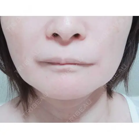 ボトックス（エラ・小顔） / ボトックス（肩） / ボトックス（眉間） / ボトックス（額） DMTC美容皮膚科 日本橋院 AFTER