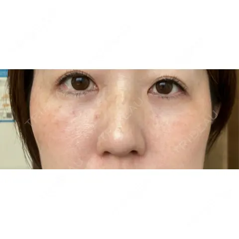 クマ治療 / 下まぶたの脂肪取り ROOTS Clinic AFTER