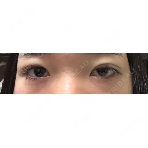 二重埋没 湘南美容クリニック 千葉センシティ院 DAY 0