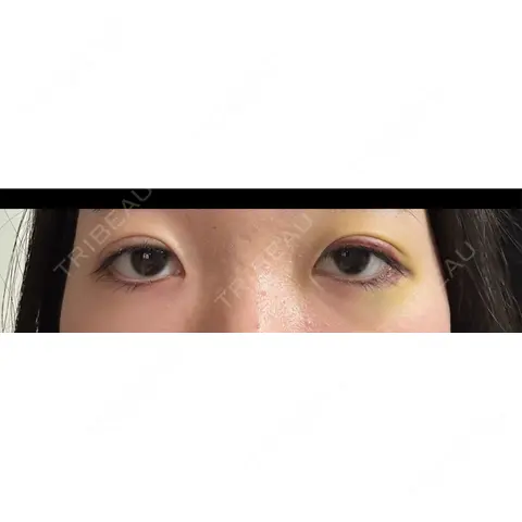 二重埋没 湘南美容クリニック 千葉センシティ院 AFTER