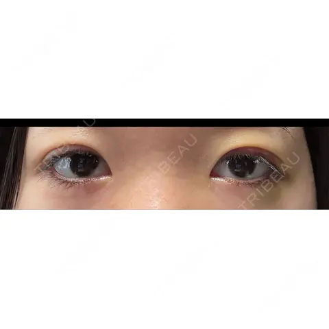 二重埋没 湘南美容クリニック 千葉センシティ院 AFTER
