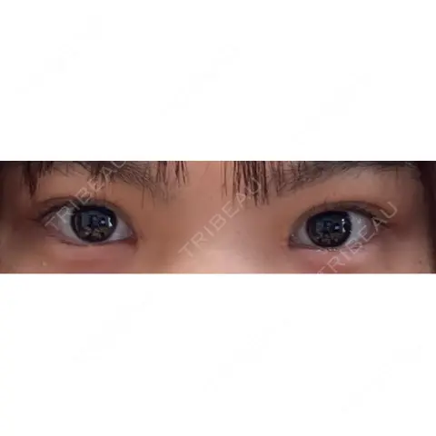 二重埋没 / 目頭切開 東京シンデレラ美容外科 池袋院 AFTER