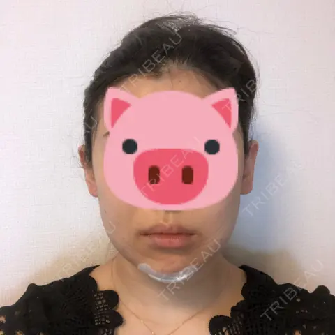 バッカルファット除去 / 脂肪吸引（顔） 藤・ナチュレ美容クリニック 恵比寿院 DAY 0