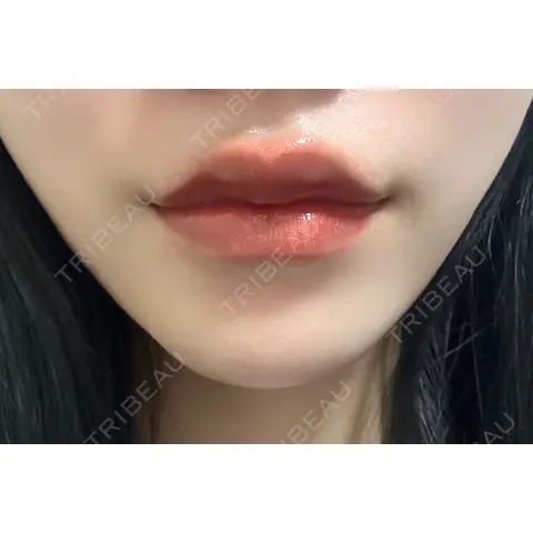 ヒアルロン酸注入（唇） / ボトックス（人中） HAAB×DREAM BEAUTY CLINIC 大阪梅田院 AFTER