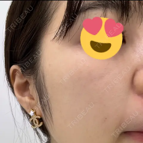 肌育注射（ジュベルックなど） DMTC美容皮膚科 日本橋院 DAY 0