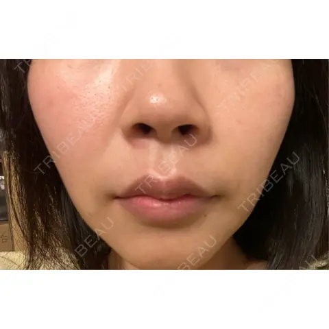 脂肪溶解注射（顔） AZ BEAUTY CLINIC AFTER