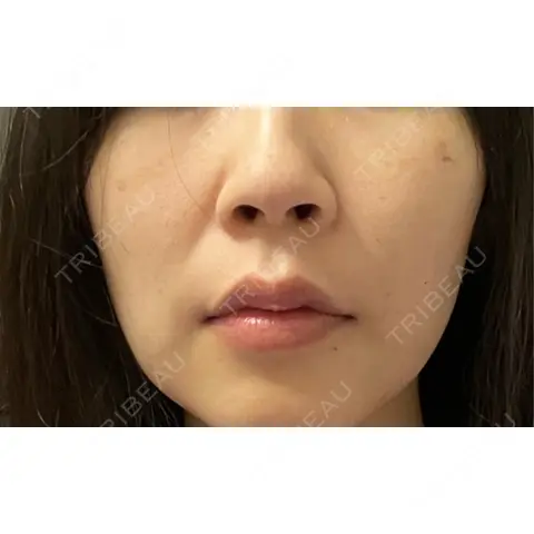 脂肪溶解注射（顔） AZ BEAUTY CLINIC AFTER