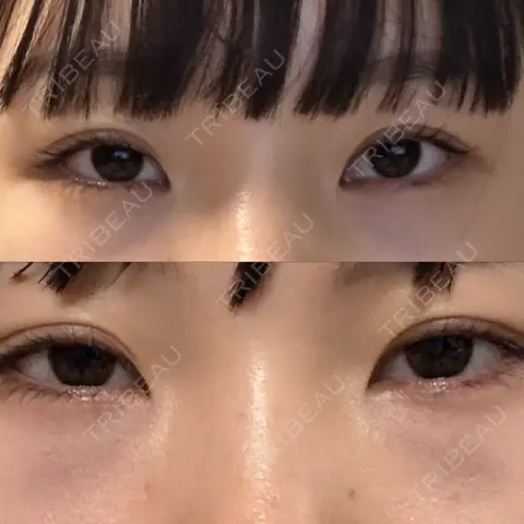 クマ治療 / 下まぶたたるみ取り / 下まぶたの脂肪取り 銀座みゆき通り美容外科 大阪梅田院 DAY 0