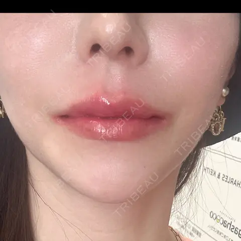ヒアルロン酸注入（唇） / ボトックス（口角） ルラ美容クリニック 名古屋栄院 DAY 0