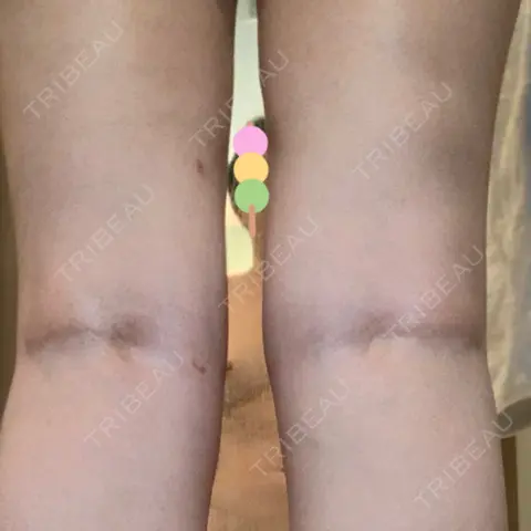 脂肪溶解注射 カイ整形外科・皮膚科 AFTER