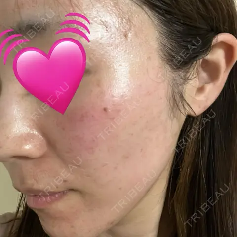 ポテンツァ ルラ美容クリニック 高田馬場院 AFTER
