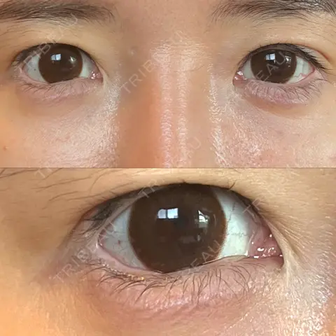 目頭切開 / タレ目形成・グラマラスライン（埋没） LOUIS CLINIC 二子玉川院【ルイクリニック】 AFTER