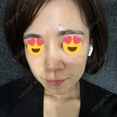 肌育注射（ジュベルックなど） DMTC美容皮膚科 日本橋院 AFTER
