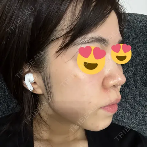 肌育注射（ジュベルックなど） DMTC美容皮膚科 日本橋院 AFTER