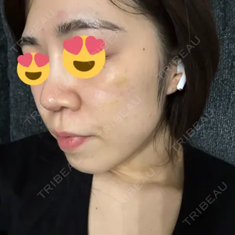 肌育注射（ジュベルックなど） DMTC美容皮膚科 日本橋院 AFTER