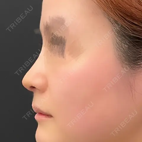 隆鼻術 / 鼻尖形成（切開） / 鼻中隔延長（切開） / 鼻柱下降・鼻唇角形成（猫手術） 4Dクリニック AFTER