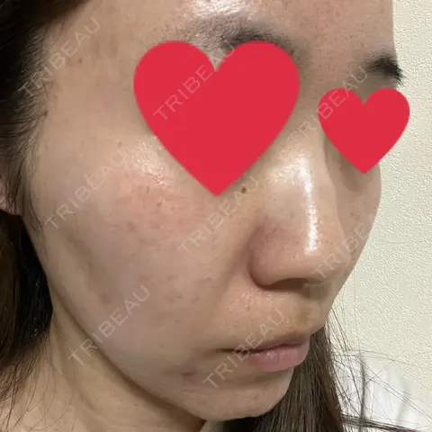ポテンツァ ルラ美容クリニック 高田馬場院 AFTER