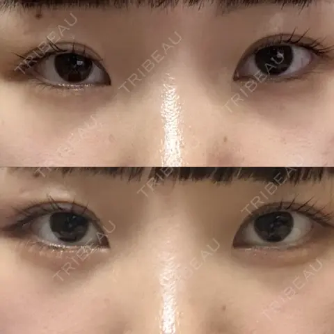 クマ治療 / 下まぶたたるみ取り / 下まぶたの脂肪取り 銀座みゆき通り美容外科 大阪梅田院 AFTER