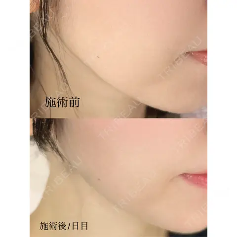 ボトックス（エラ・小顔） AYANAフィラーズクリニック 渋谷院 AFTER