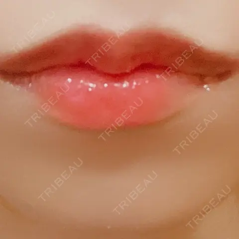 口角挙上 / その他（口元） R Beauty CLINIC 銀座院 AFTER