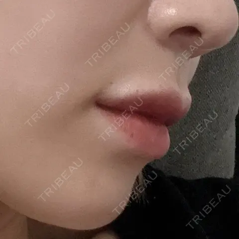 ヒアルロン酸注入（唇） Wi Clinic （ウィ クリニック）心斎橋院 AFTER