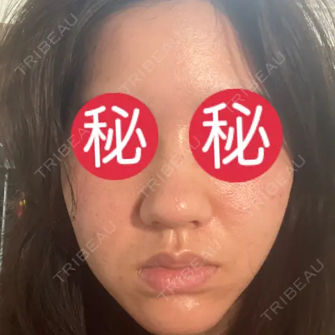ポテンツァ L‘amour clinic Tokyo【ラムールクリニック東京】 DAY 0