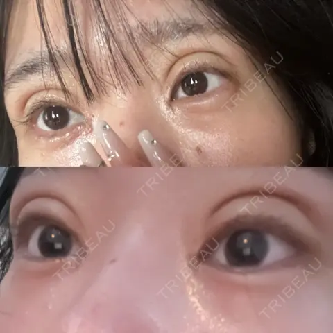 二重切開 / 目頭切開 / 眼瞼下垂（切開） / ヒアルロン酸注入（涙袋） 東京シンデレラ美容外科 池袋院 DAY 12