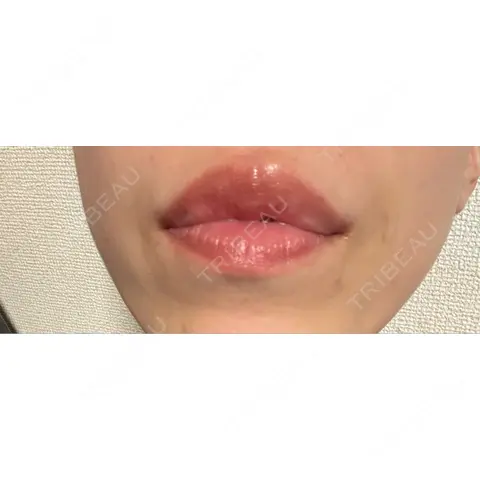 ヒアルロン酸注入（唇） / ボトックス（口角） カジュアルクリニック 平塚院 AFTER