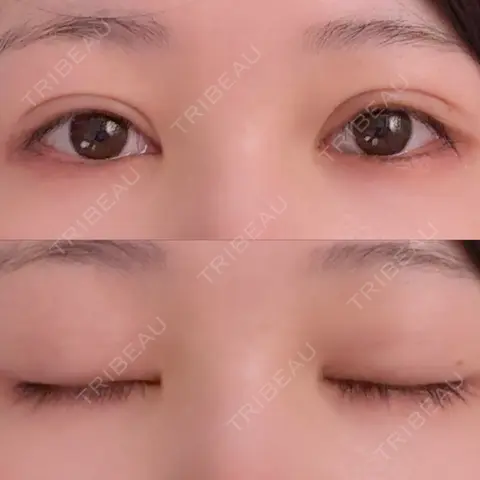 二重埋没 / 自然癒着法 Brandnew Beauty Clinic AFTER