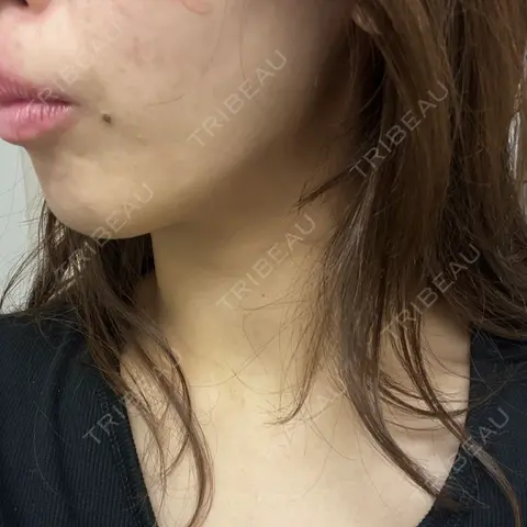 脂肪吸引（顔） Mods Clinic（モッズクリニック） 東京院 AFTER