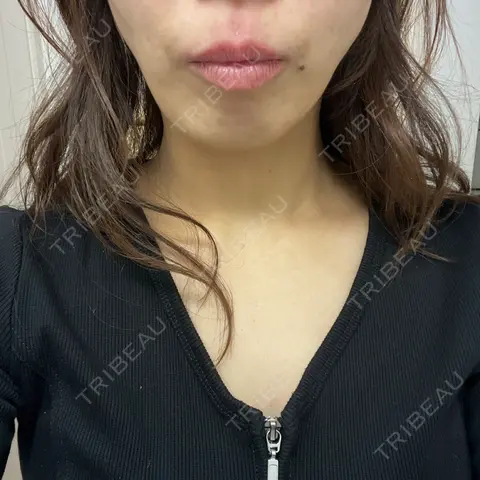 脂肪吸引（顔） Mods Clinic（モッズクリニック） 東京院 AFTER