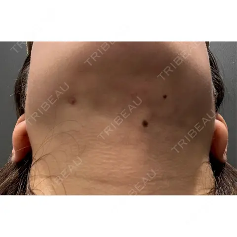 糸リフト / 脂肪吸引（顔） 9BeautyClinic AFTER