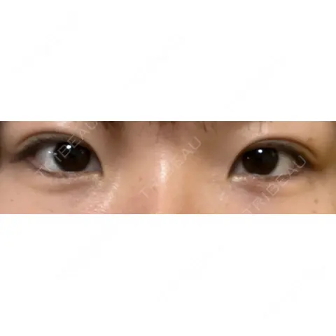 二重埋没 / 自然癒着法 Brandnew Beauty Clinic AFTER